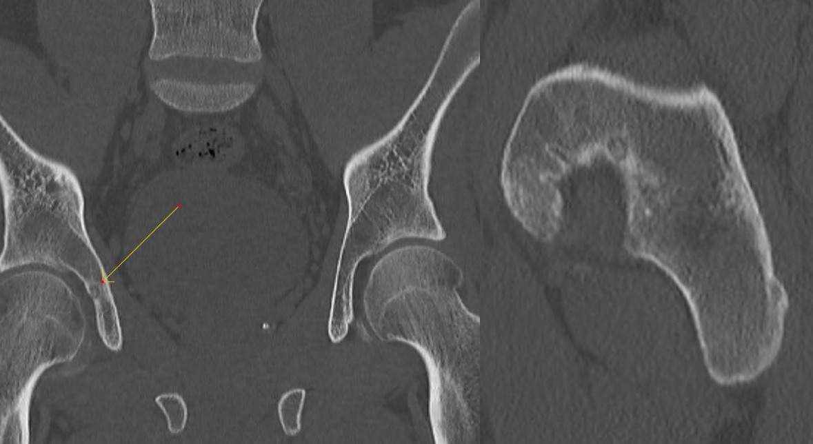 Figure 4 for case Osteoid osteoma ( RID4005 )